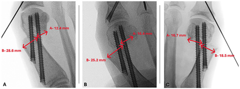 Time to Radiographic Union Following Minimally Invasive META Procedure for Hallux Valgus.