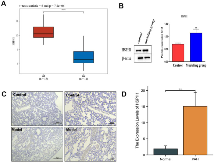 Bioinformatics Analysis Identifies a Potential Key Gene in the Pathogenesis of Pulmonary Hypertension-HSPH1.