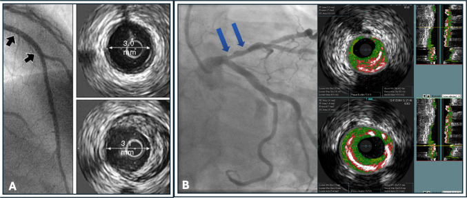 Intravascular Coronary Imaging Update: Advances, Clinical Applications, and Future Directions.