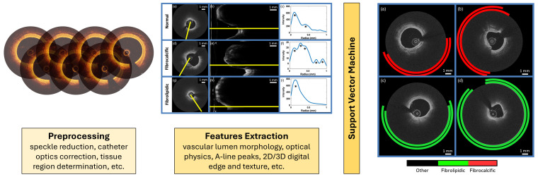 Artificial Intelligence-based Approaches for Characterizing Plaque Components From Intravascular Optical Coherence Tomography Imaging: Integration Into Clinical Decision Support Systems.