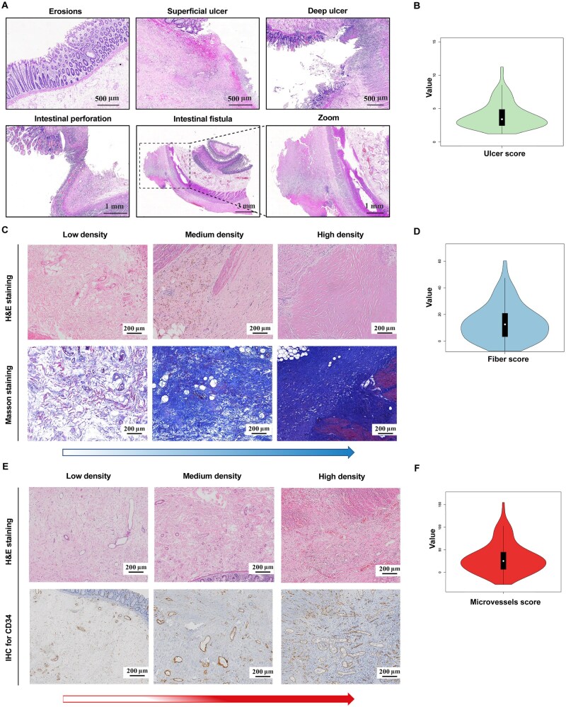 Pathological classification of chronic radiation-induced intestinal injury and its clinical implications.