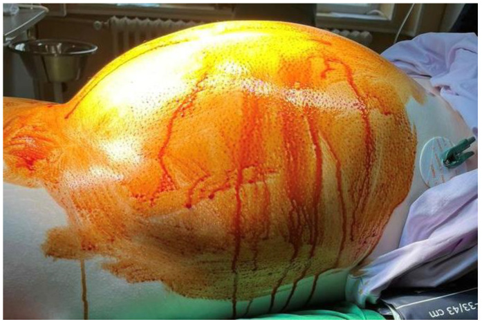 Extremely Rare Case of a Giant Paratubal Cyst, Coexisting with a Mucinous Cystadenoma, Surgically Treated Through Laparoscopy-A Case Report and Review of the Literature.