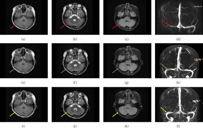 Pediatric Posttraumatic Cerebral Venous Sinus Thrombosis: Successful Resolution With Rivaroxaban.