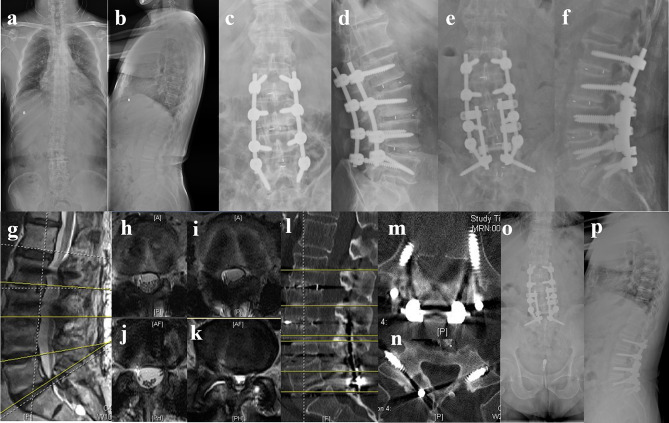 The Safety and Effectiveness of Multi-Segment Cortical Bone Trajectory Screws in Adult Degenerative Scoliosis with Stenosis Among the Elderly: Minimum 5-year Follow-up Study.