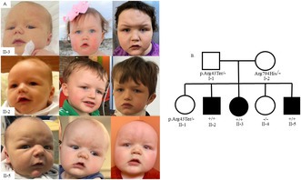 Three Siblings With an Attenuated Presentation of Perlman Syndrome: A Case Report and Literature Review.