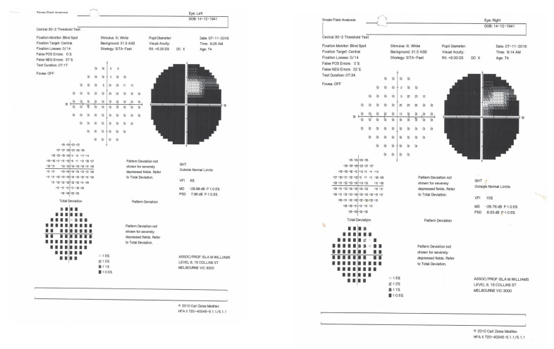 Visual Perception and Fixation Patterns in an Individual with Ventral Simultanagnosia, Integrative Agnosia and Bilateral Visual Field Loss.