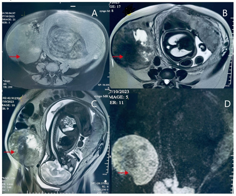 Pregnancy-Associated Giant Abdominal Desmoid Tumor: A Case Report of Active Surveillance and Surgical Management.