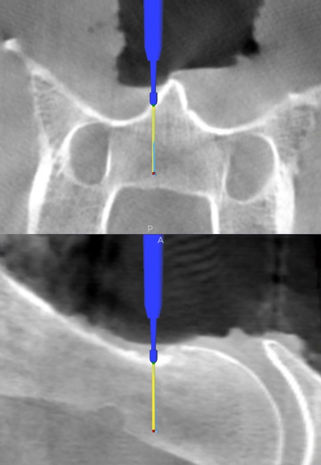 Accuracy of computer-assisted drilling of equine cervical vertebral bodies using a purpose-built cervical frame-An experimental cadaveric study.