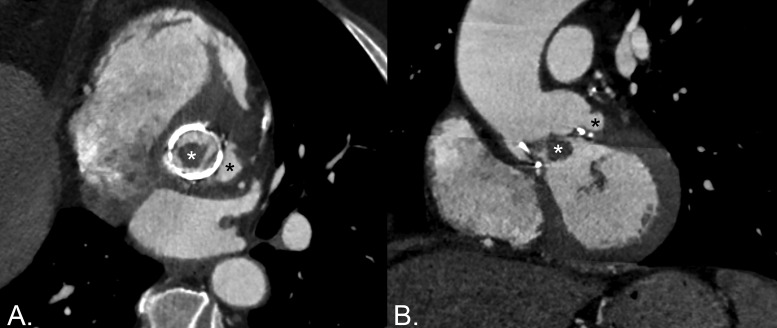 Cardiac CT in Infective Aortic Prosthetic Valve Endocarditis.