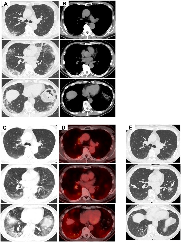 Alveolar Sarcoidosis Mimicking Idiopathic Interstitial Pneumonia Without Mediastinal Lymphadenopathy.