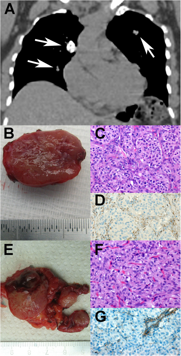 ERRATUM: Aberrant DNA hypermethylation of SDHC: a novel mechanism of tumor development in Carney triad.
