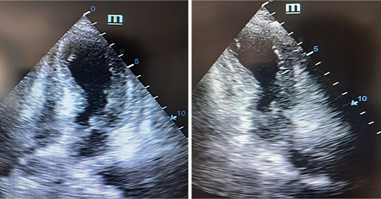 Kounis Syndrome Induced by Atezolizumab in a Patient with Non-Small Cell Lung Cancer: A Case Report.