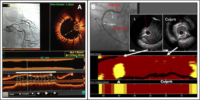 Intravascular Coronary Imaging Update: Advances, Clinical Applications, and Future Directions.