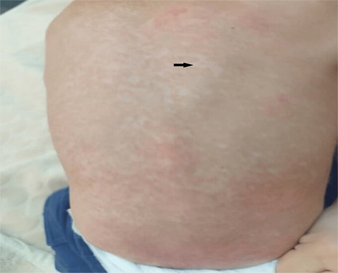 A case report of cutaneous Langerhans cell Histiocytosis in an infant: a therapeutic challenge.