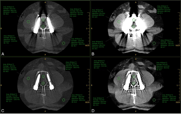 The Clinical Value of the MAR + Metal Artifact Reduction Algorithm for Postoperative Assessment of Lumbar Internal Fixation.
