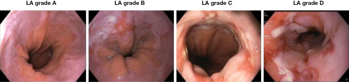 Drug treatment strategies for erosive esophagitis in adults: a narrative review.