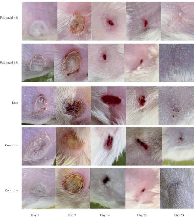 Efficacy of Topical Folic Acid in the Healing of Deep Second-Degree Burn Wound via Redox Modulation in Rat.