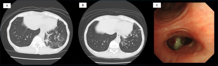 A Case of <i>Haemophilus influenzae</i> Colonisation in Bronchiectasis Following COVID-19: Post-COVID-19 Bronchiectasis as a Structural Hotbed for Chronic Airway Infections.