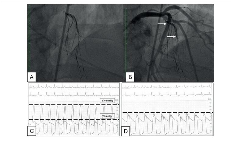 Septal Artery Embolization with Onyx® In Hypertrophic Cardiomyopathy: Report of Two Cases.