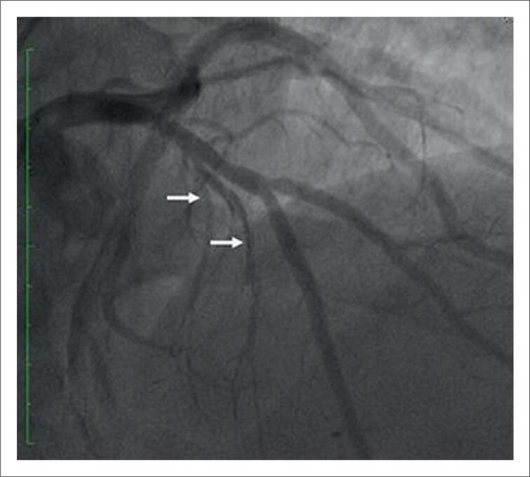 Septal Artery Embolization with Onyx® In Hypertrophic Cardiomyopathy: Report of Two Cases.
