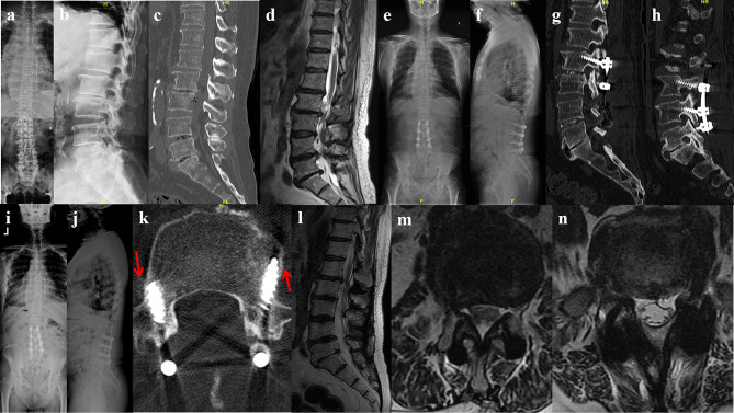 The Safety and Effectiveness of Multi-Segment Cortical Bone Trajectory Screws in Adult Degenerative Scoliosis with Stenosis Among the Elderly: Minimum 5-year Follow-up Study.