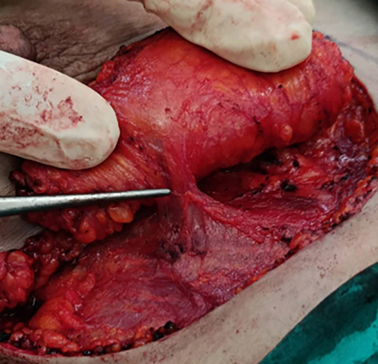 Implication of indocyanine green angiography for chest wall perforator flap reconstruction in breast-conserving surgery.