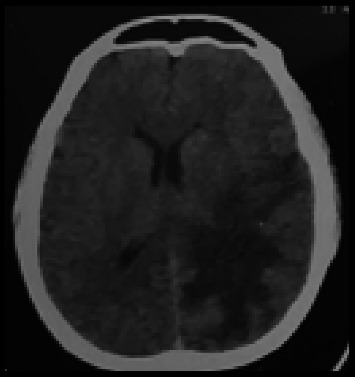 Cerebral Schistosomiasis in the Napu Valley, Central Sulawesi, Indonesia.
