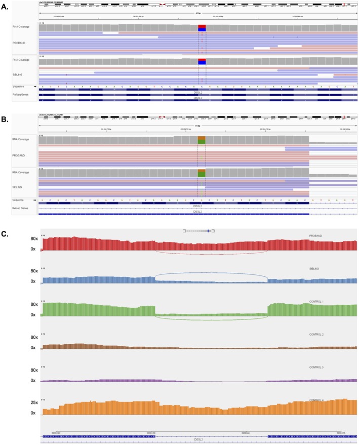 Three Siblings With an Attenuated Presentation of Perlman Syndrome: A Case Report and Literature Review.