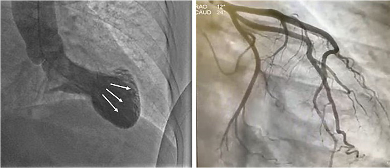 Kounis Syndrome Induced by Atezolizumab in a Patient with Non-Small Cell Lung Cancer: A Case Report.