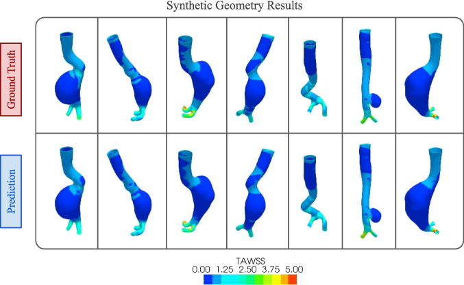 Rapid wall shear stress prediction for aortic aneurysms using deep learning: a fast alternative to CFD.