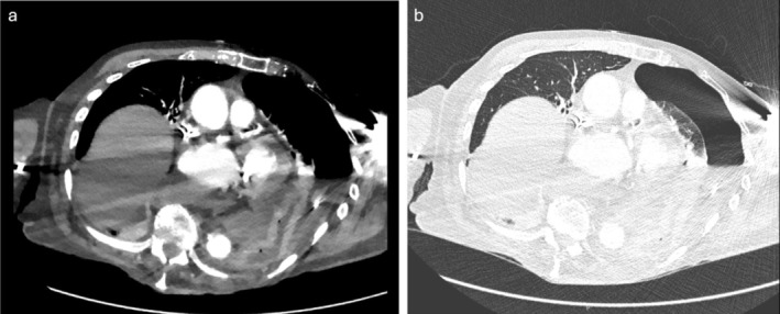 A Case of Complicated Hiatus Hernia Rupture Causing Tension Hydropneumothorax.
