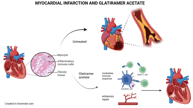 Glatiramer Acetate Reduces Risk of Cardiovascular Disease and Myocardial Infarction.