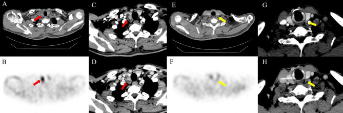 Comparison of four-dimensional CT and Sestamibi SPECTCT in the localization management of primary hyperparathyroidism.