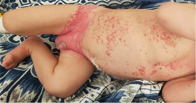 A case report of cutaneous Langerhans cell Histiocytosis in an infant: a therapeutic challenge.