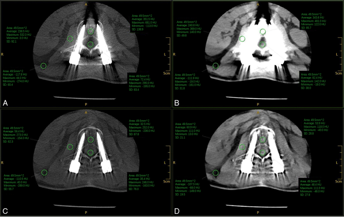 The Clinical Value of the MAR + Metal Artifact Reduction Algorithm for Postoperative Assessment of Lumbar Internal Fixation.