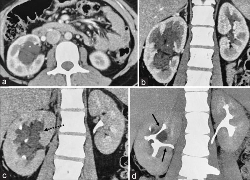 Renal sinus lymphangiectasia: An uncommon entity.