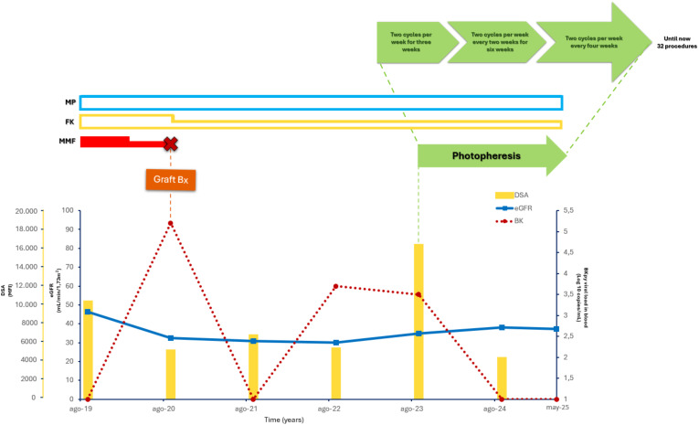 Case Report: Extracorporeal photopheresis for BK virus nephropathy as a novel treatment for high-risk rejection kidney transplant recipient.