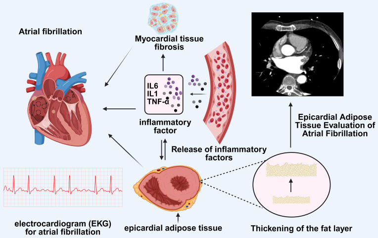 Recent Advances in Inflammation-Associated Epicardial Adipose Tissue for Atrial Fibrillation Patients.