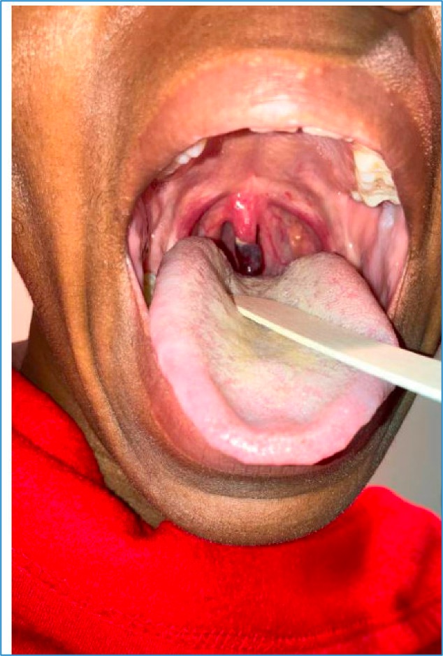 Case Report of Post-Operative Uvular Necrosis Following Intubation.