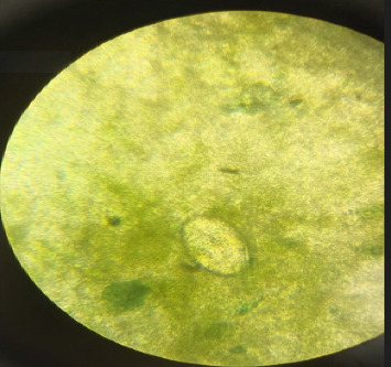 Cerebral Schistosomiasis in the Napu Valley, Central Sulawesi, Indonesia.