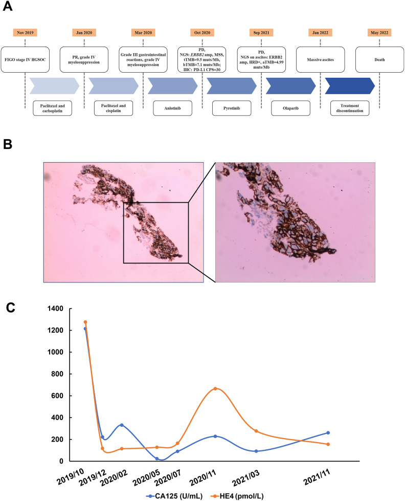 A stage IV high-grade serous ovarian cancer patient carrying <i>ERBB2</i> amplification and ERBB2 overexpression benefits from late-line pyrotinib treatment: A case report.