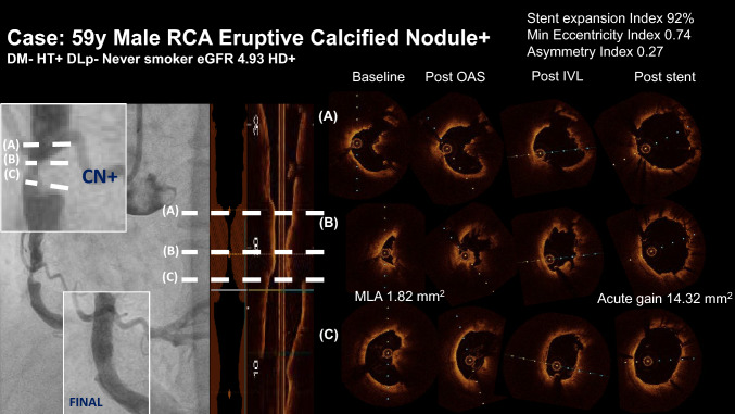 Dual-Prep registry: atherectomy devices and intravascUlAr lithotripsy for the PREParation of heavily calcified coronary lesions registry.