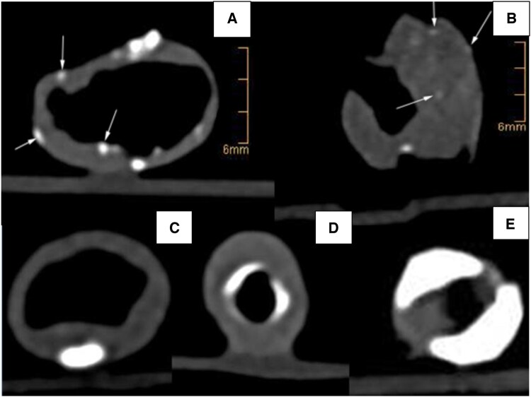 Ultra-high-resolution and dual-energy computed tomography of carotid artery plaques differentiate symptomatic and asymptomatic patients by novel volumetric analysis.