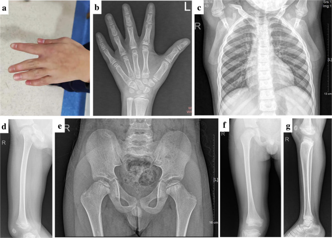 Concurrent mutations in RNU4ATAC, PLEC, and CD96 in a child with severe short stature and skeletal dysplasia: a case report.