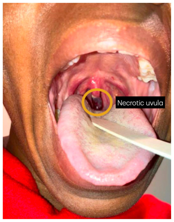Case Report of Post-Operative Uvular Necrosis Following Intubation.