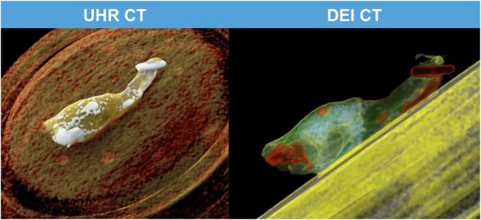 Ultra-high-resolution and dual-energy computed tomography of carotid artery plaques differentiate symptomatic and asymptomatic patients by novel volumetric analysis.