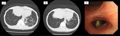 A Case of <i>Haemophilus influenzae</i> Colonisation in Bronchiectasis Following COVID-19: Post-COVID-19 Bronchiectasis as a Structural Hotbed for Chronic Airway Infections.