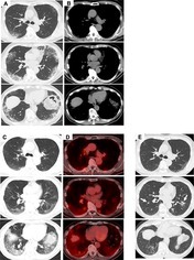 Alveolar Sarcoidosis Mimicking Idiopathic Interstitial Pneumonia Without Mediastinal Lymphadenopathy.