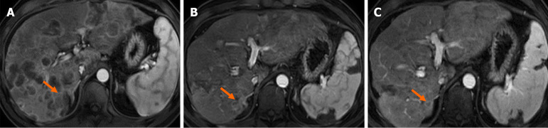 Molecular tumor boards in pancreatic cancer with liver metastasis: A case report.