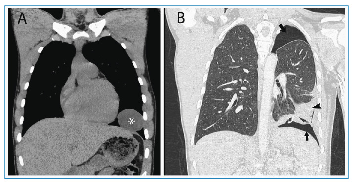 Hydatid Cyst Rupture Due to Albendazole Treatment.
